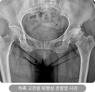 좌측 고관절 퇴행성 관절염 사진