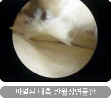 파열된 내측 반월상연골판