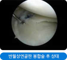 반월상연골판 봉합술 후 상태