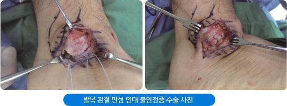 발목 관절 만성 인대 불안정증 수술 사진