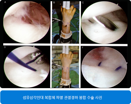 섬유삼각인대 복합체 파열 관절경하 봉합 수술 사진