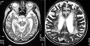 뇌 자기공명 영상(MRI)