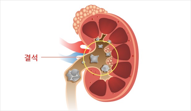 요로결석